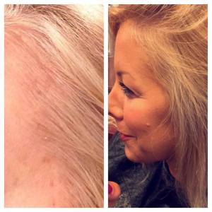 client experienced hair loss from surgery, and she uses our product faithfully twice a week.